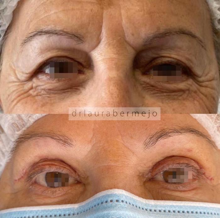 Antes y después de paciente después de ser sometida a blefaroplastia.