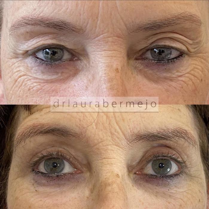 Resultado de blefaroplastia, rejuvenecimiento de la mirada.