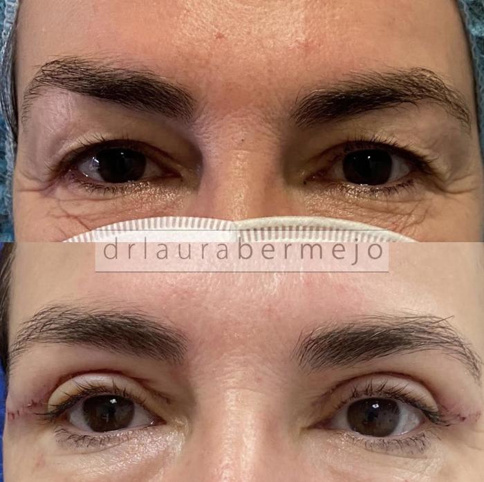 Resultados de cirugía de blefaroplastia, comparando antes y después.