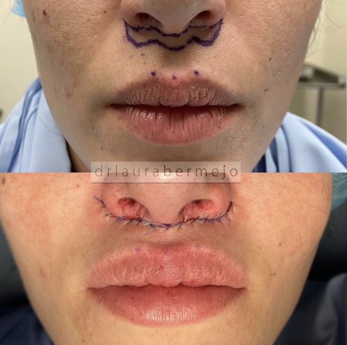 Resultados de Liplift, antes e despois.